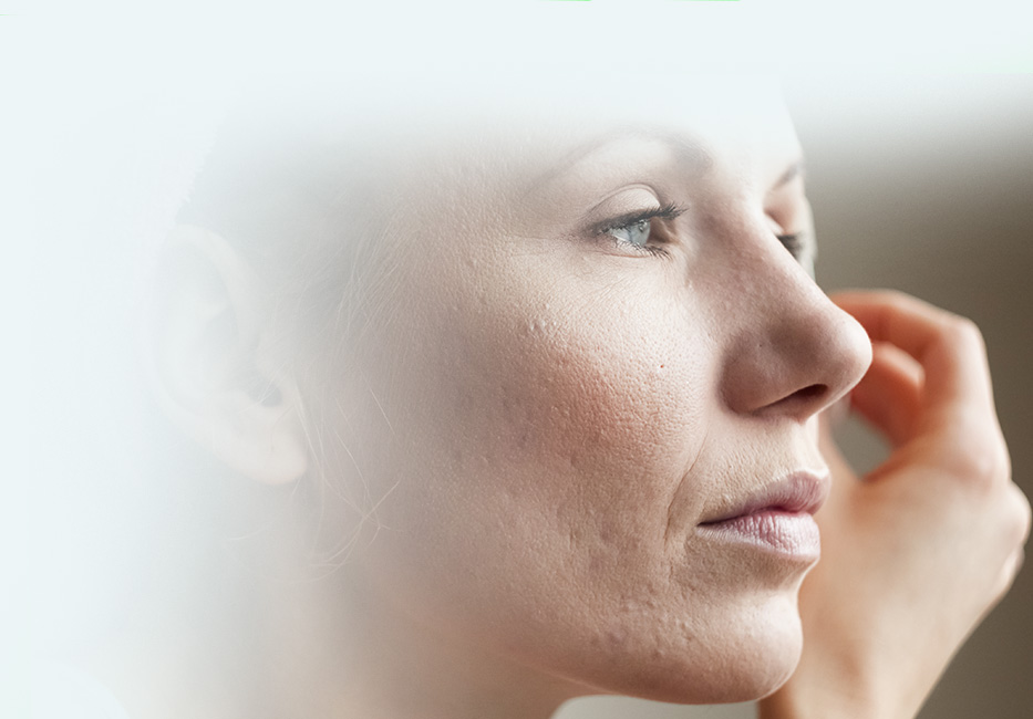 Rosacea