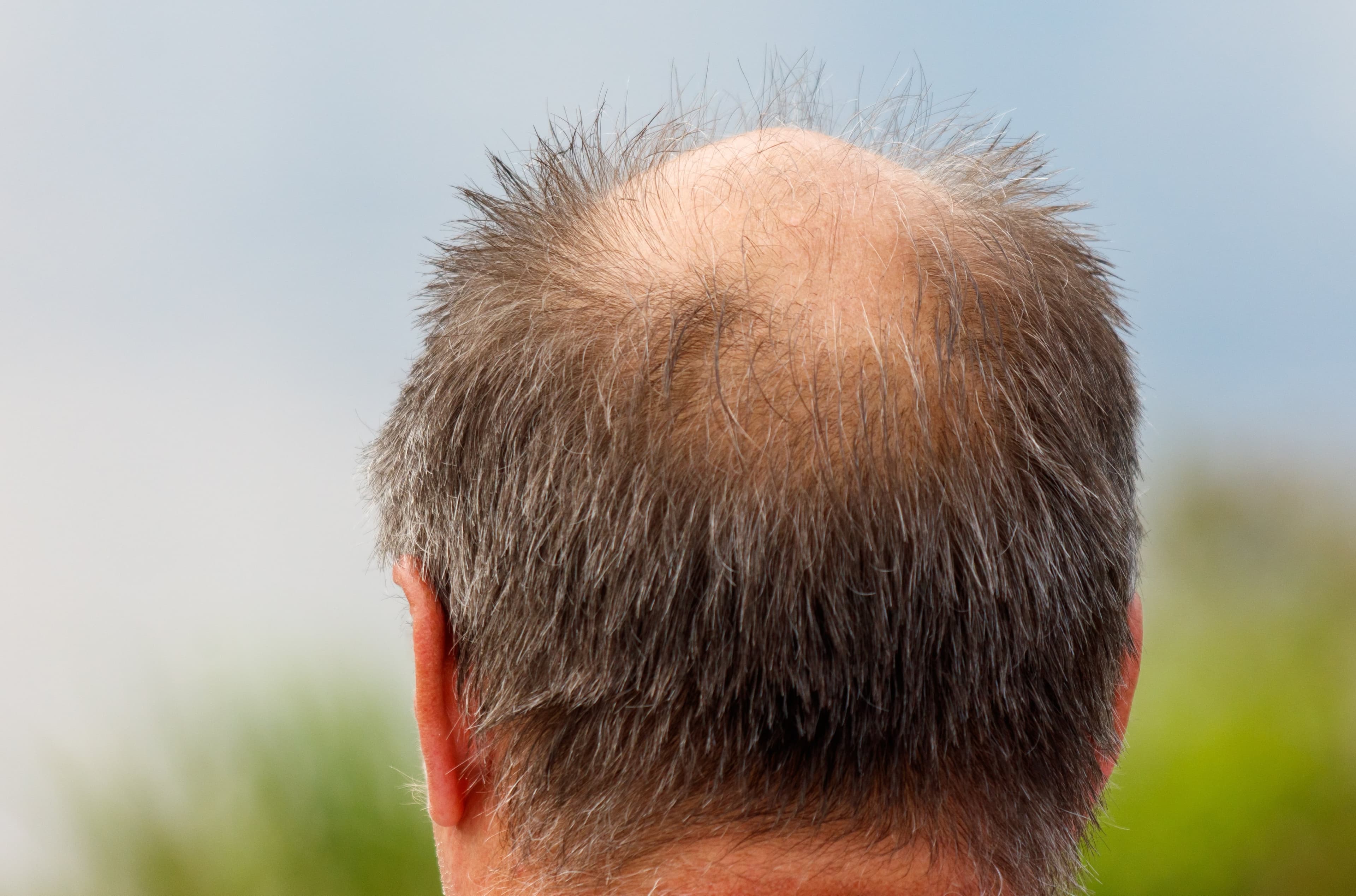Rückansicht eines Mannes mittleren Alters mit schütterem Haar und einer Glatze am Hinterkopf, die den männlichen Haarausfall veranschaulicht.